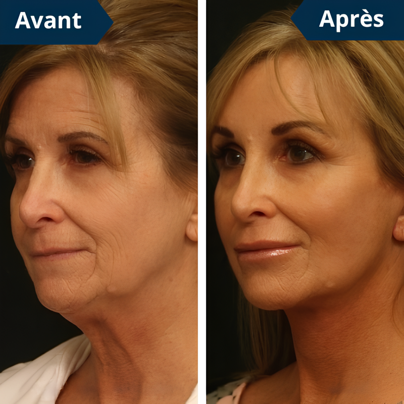 🔥54% de réduction🔥 FaceLift PRO™ – Adieu Double Menton ✨ Crème OFFERTE Aujourd’hui 💕