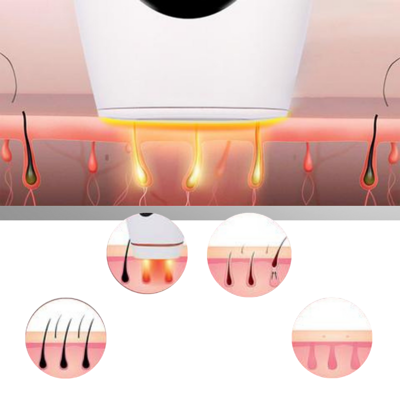 Appareil d'épilation laser IPL